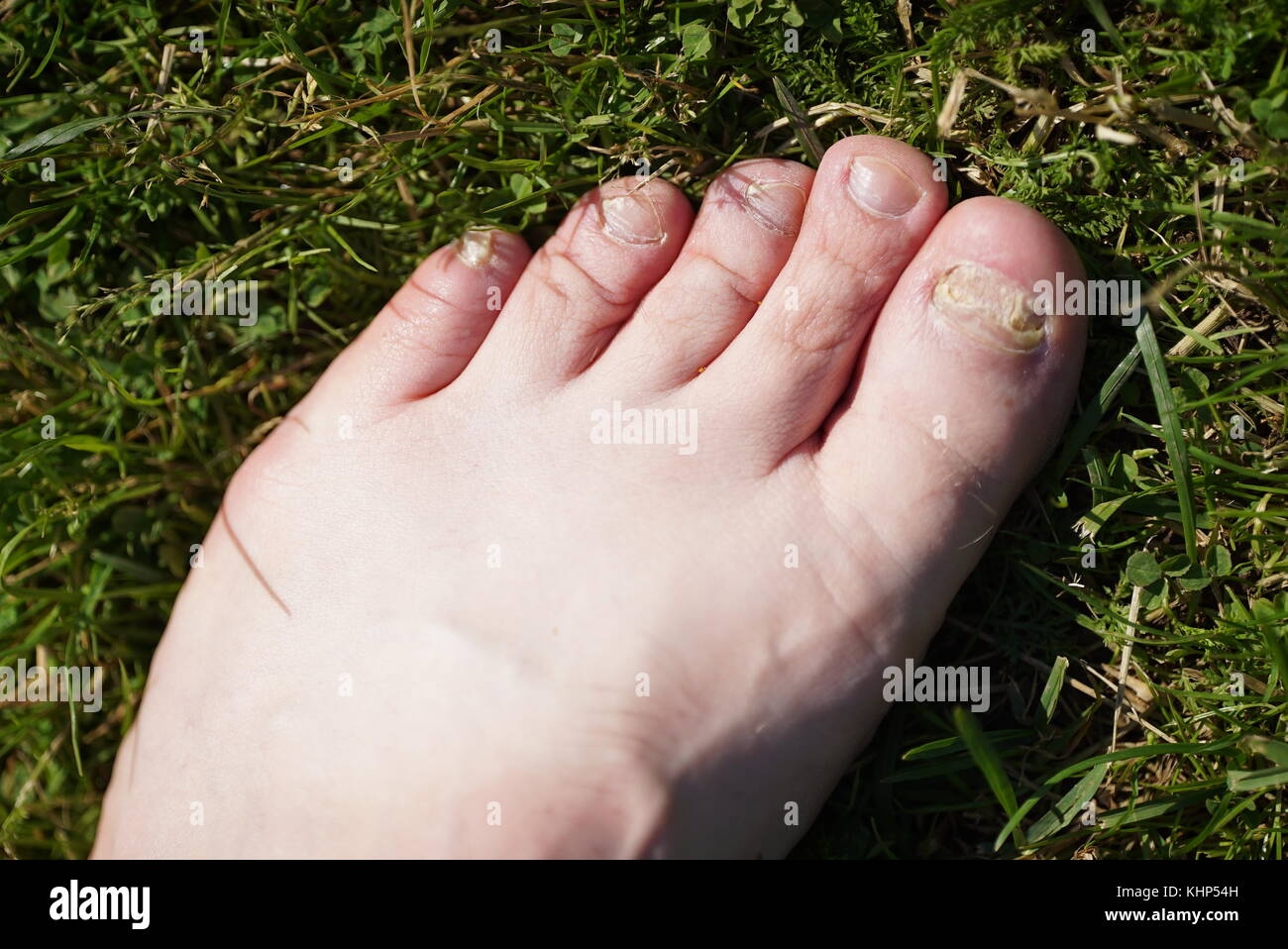 Onychomycosis. Fungal infection of nails of feet Stock Photo