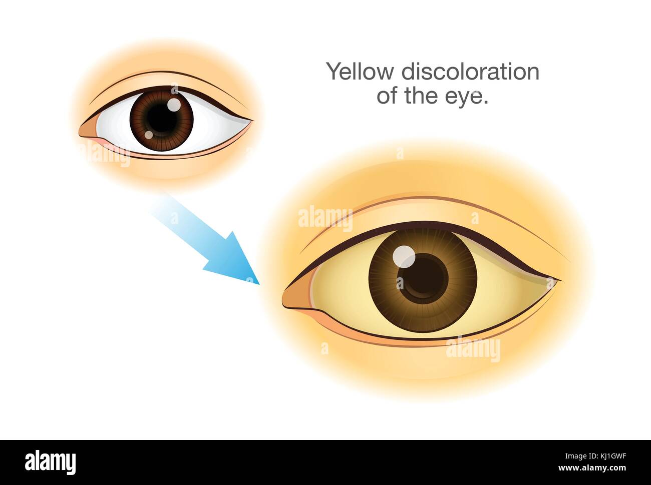 Normal human eye changing to Yellowing. Stock Vector