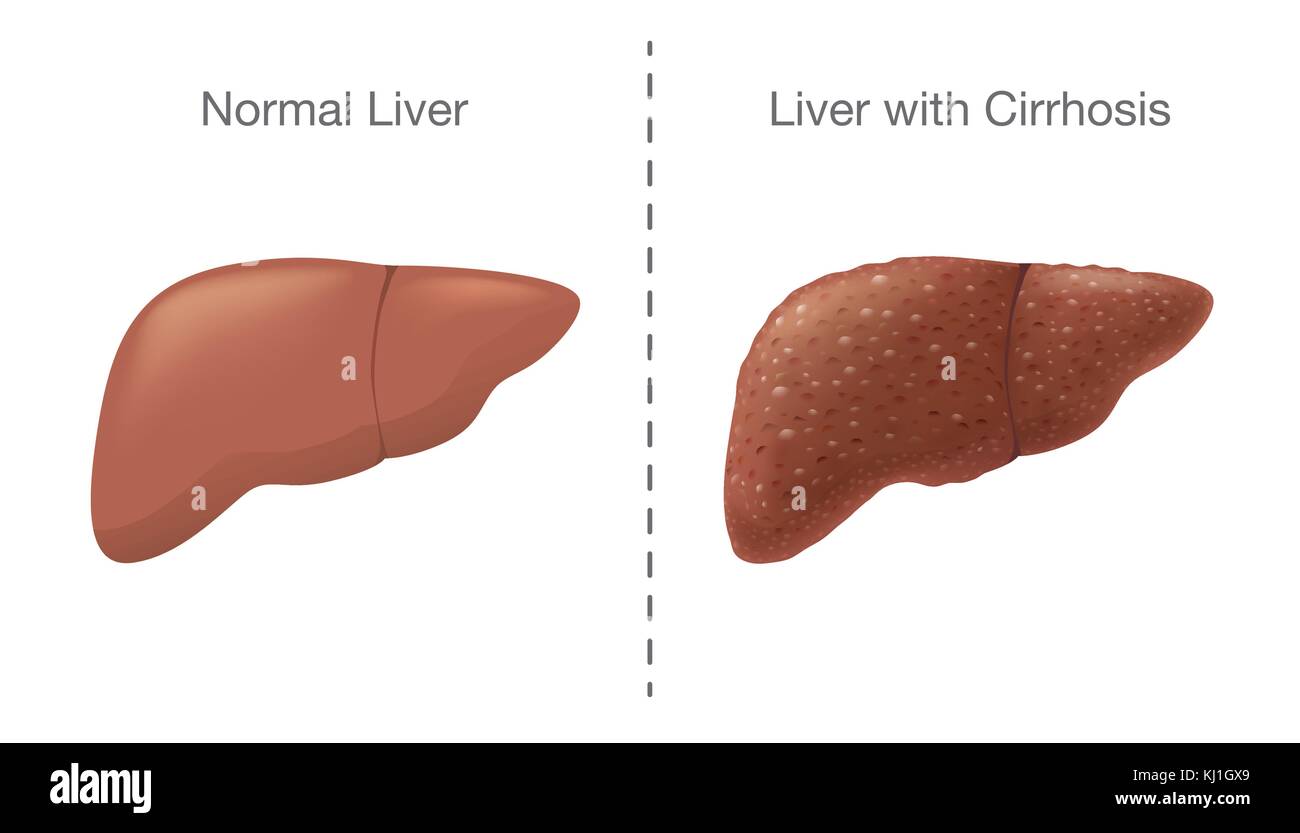 The Comparison between Healthy liver and Cirrhosis. Stock Vector