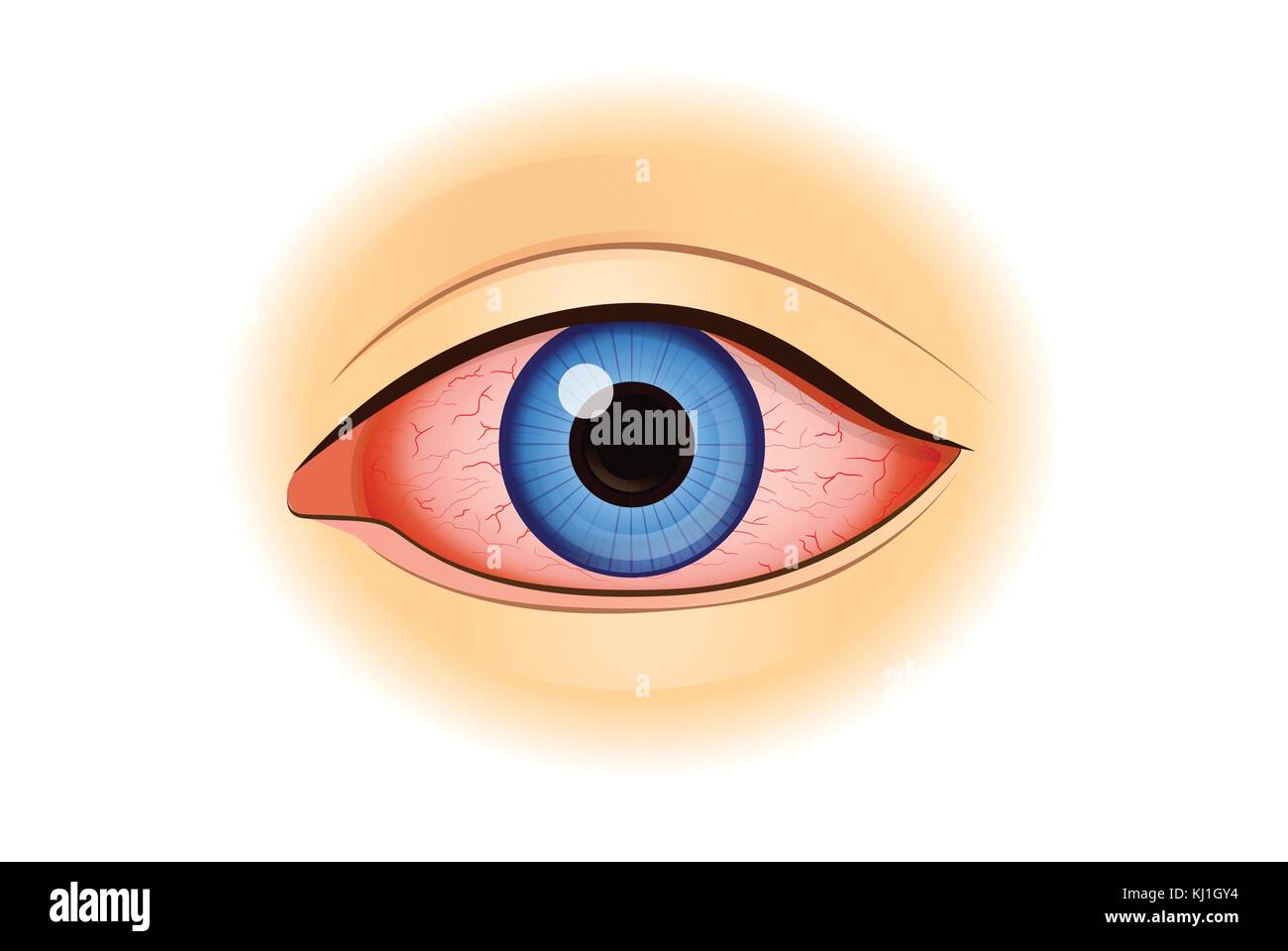 Eye redness symptom of human isolated on white. Stock Vector
