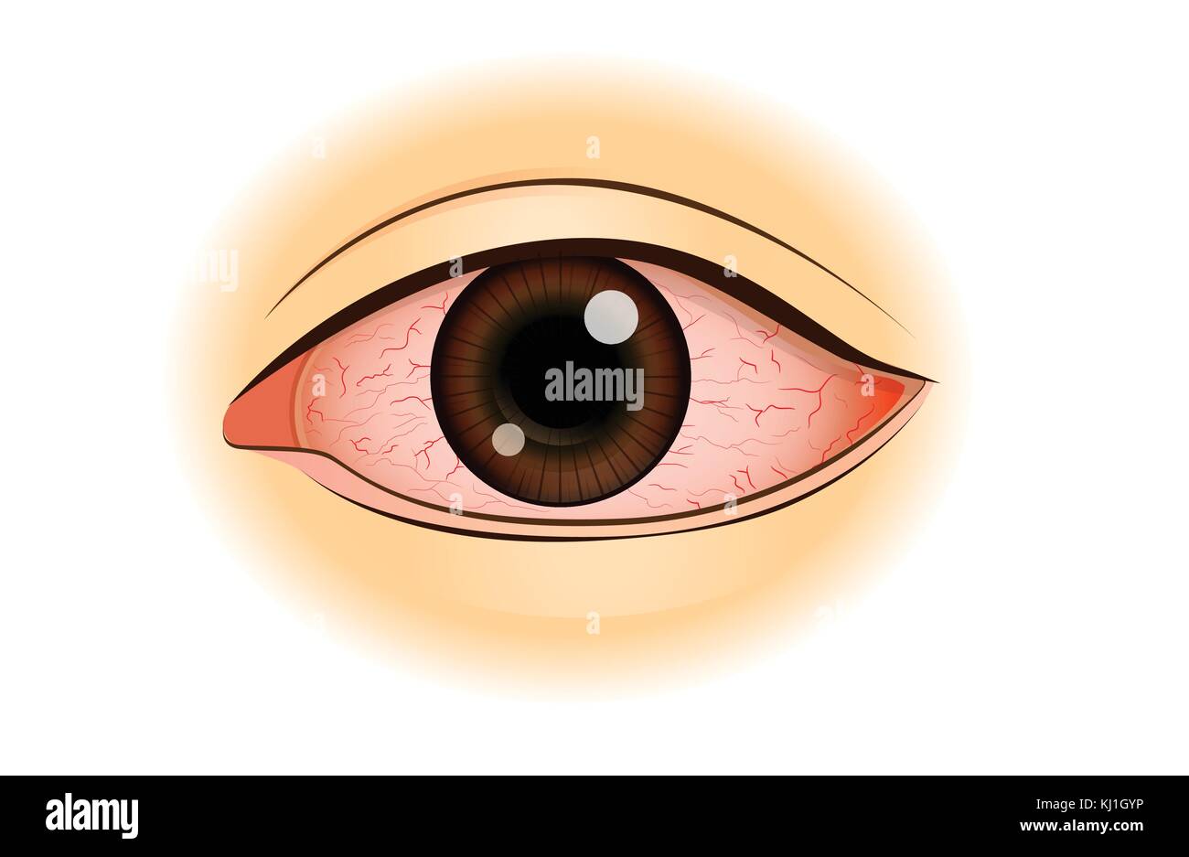 Eye redness symptom of Asian people. Stock Vector