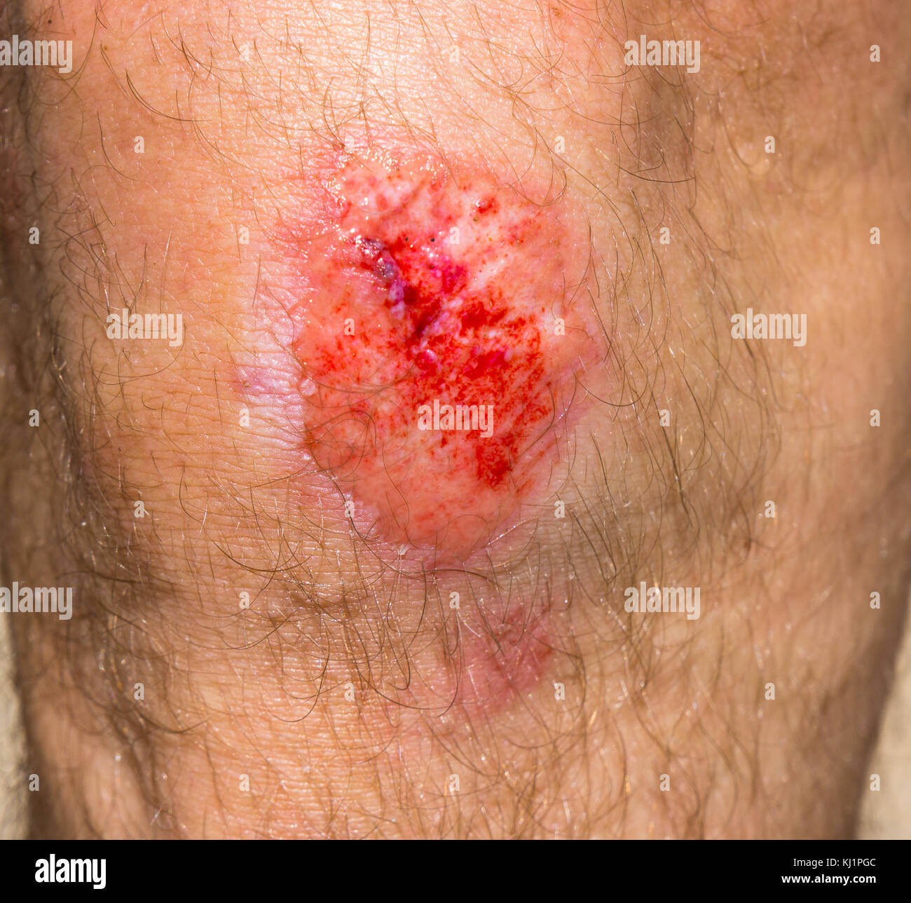Wound on a knee Stock Photo