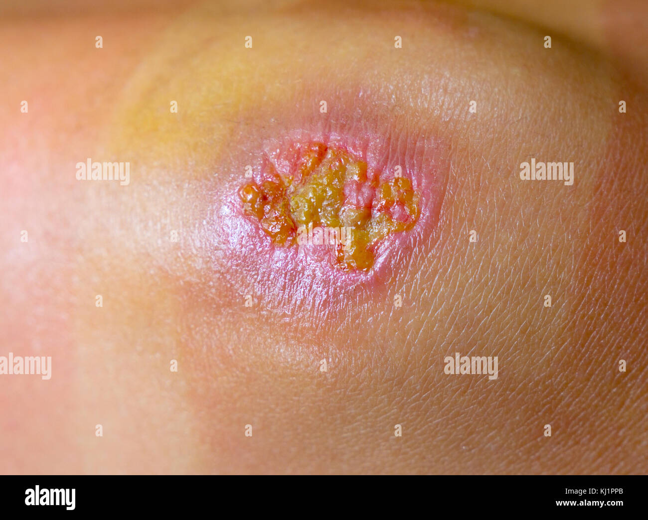 Purulent wound on the knee Stock Photo