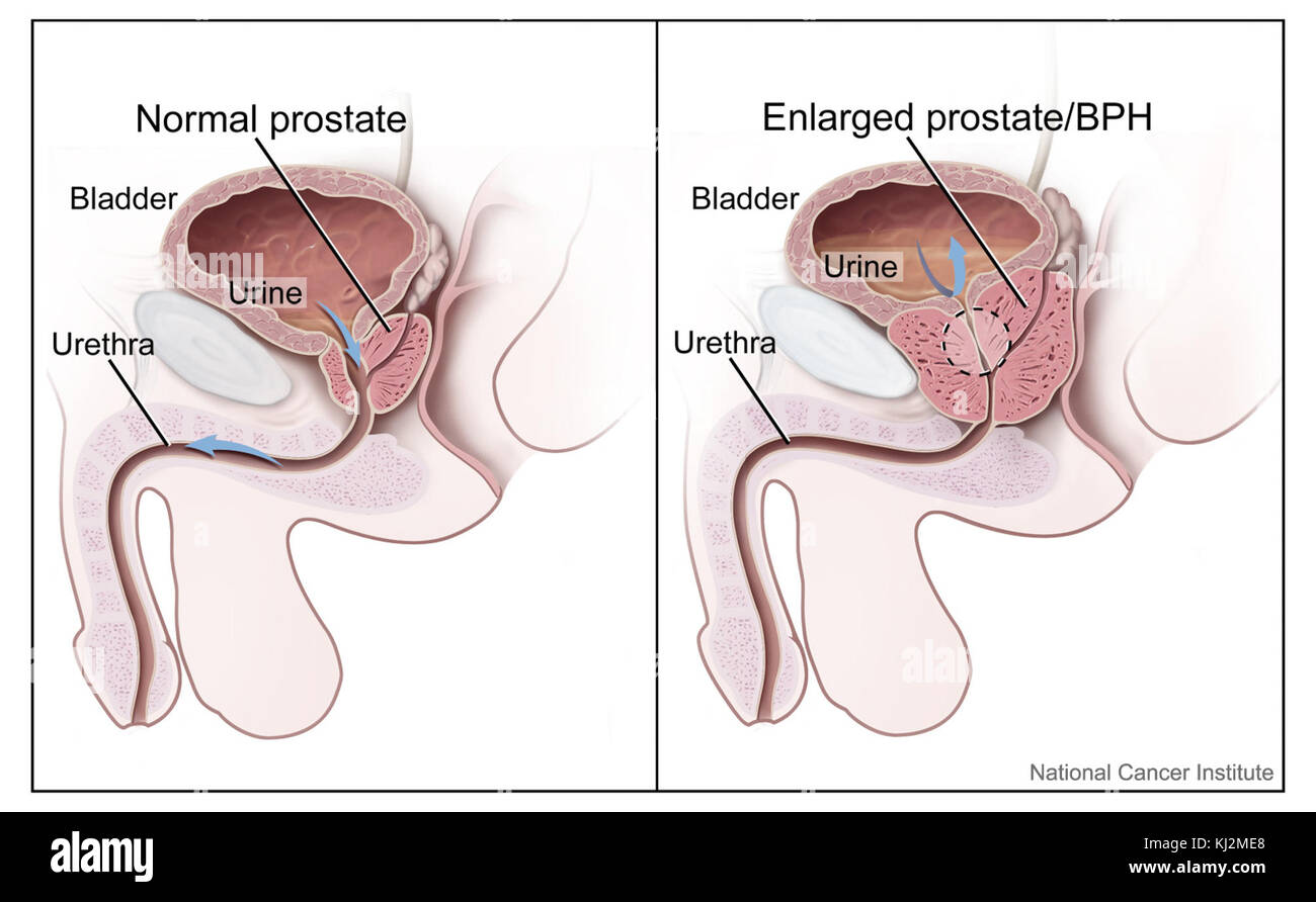 Предстательная железа это простата. Предстательная железа у мужчин. Секрет предстательной железы у мужчин.