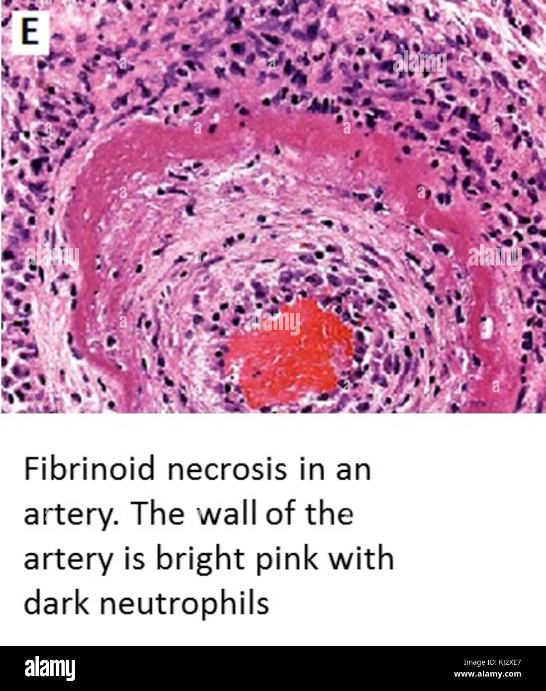 Fibrinoid necrosis in an artery Stock Photo - Alamy