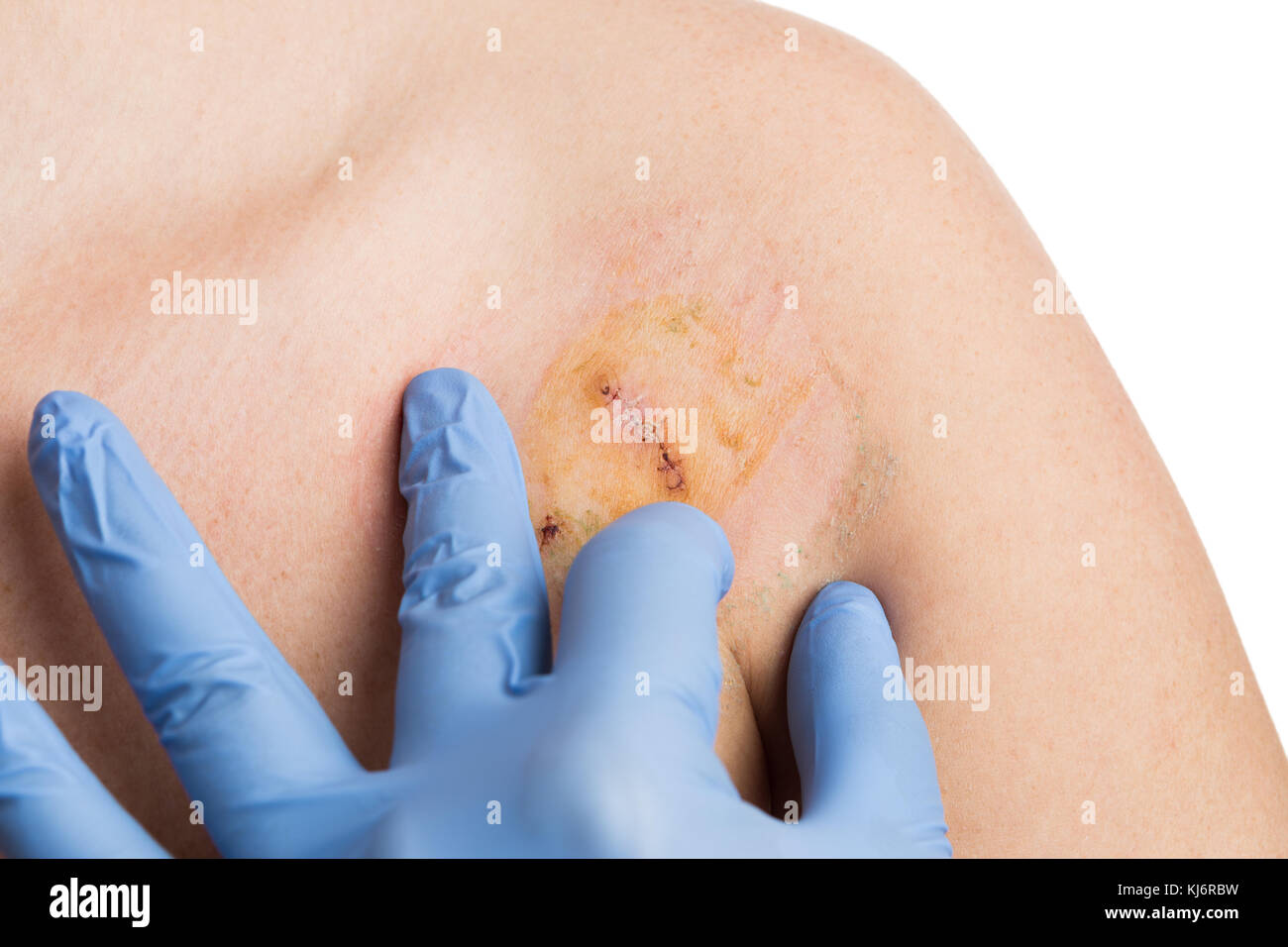 Doctor hand checking surgery suture after mole and bandage removal Stock Photo