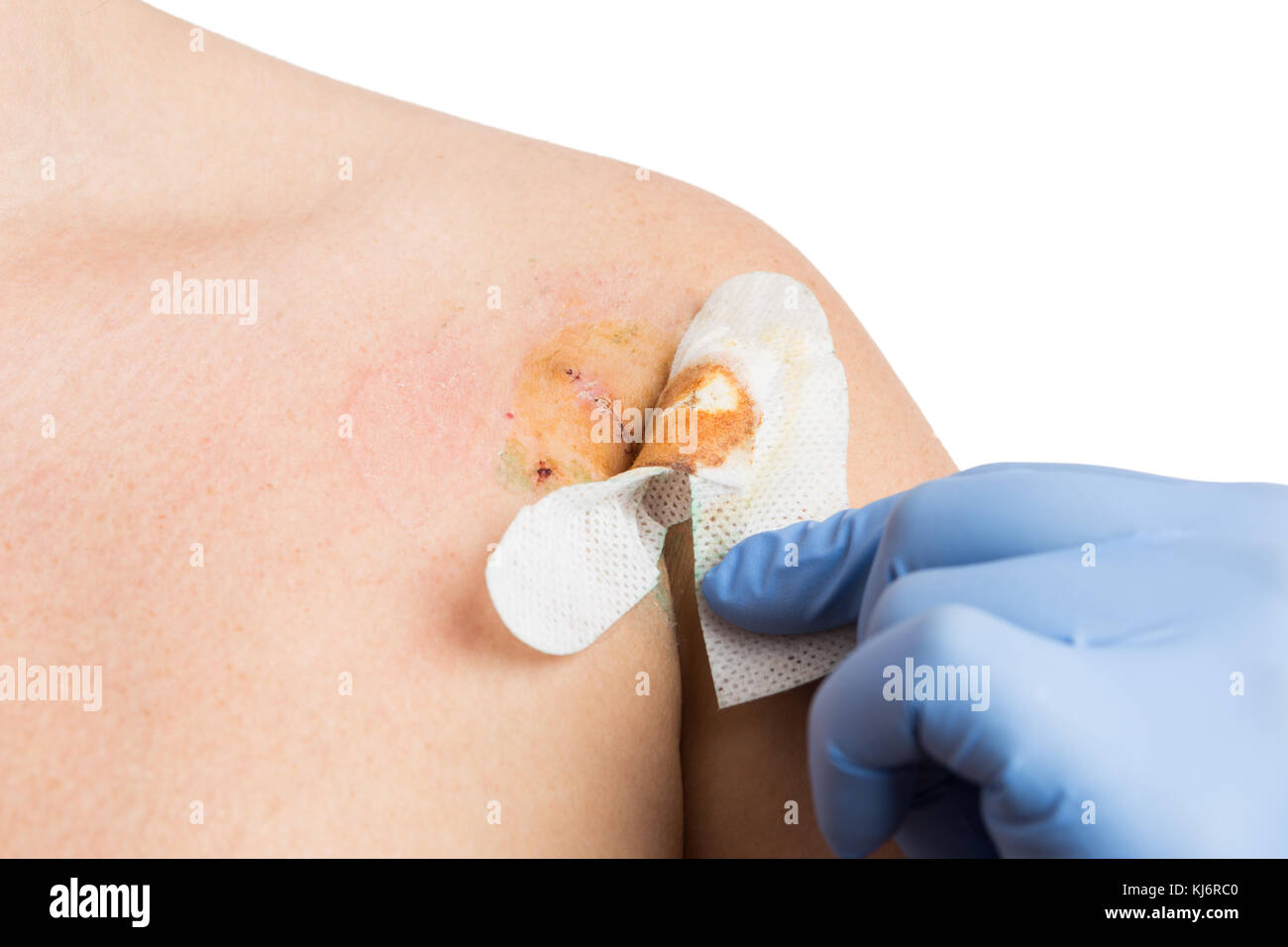 Doctor hand removing bandage after mole removal surgery and checking stitches Stock Photo