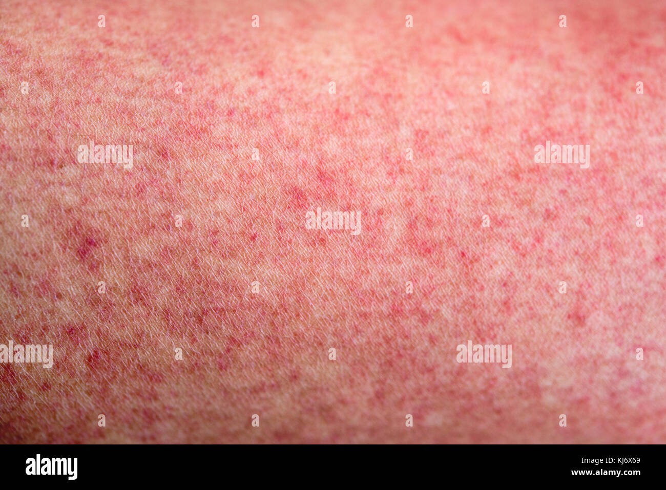Close up human skin with dengue fever red rashes Stock Photo