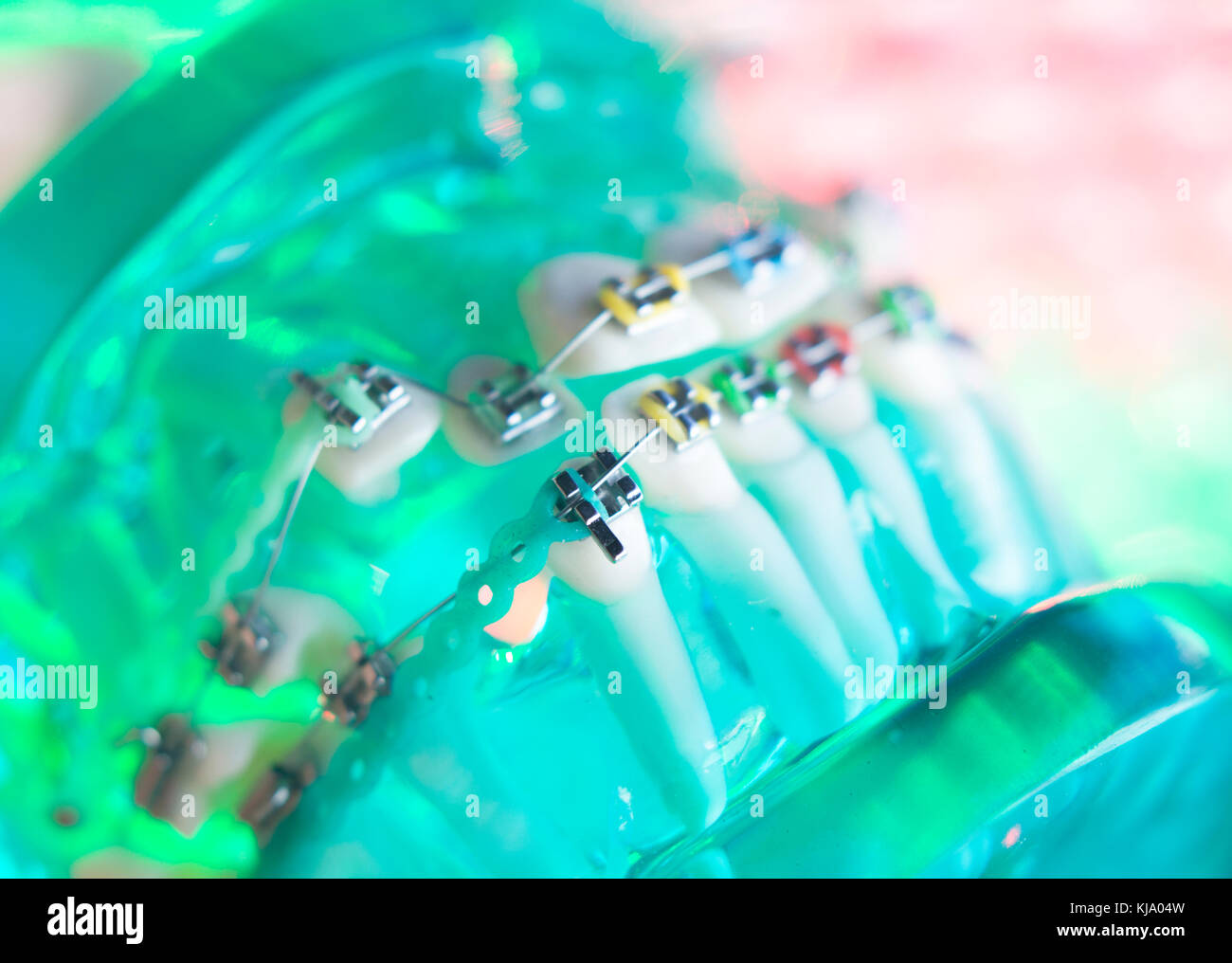 Dental teeth retainers metal aligners brackets to straighten teeth in orthodontic dentistry