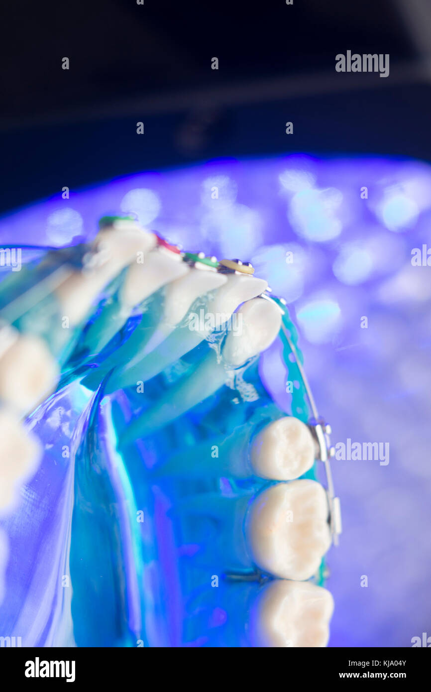 Dental teeth retainers metal aligners brackets to straighten teeth in orthodontic dentistry