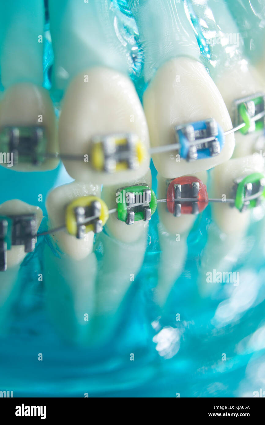 Dental teeth retainers metal aligners brackets to straighten teeth in orthodontic dentistry