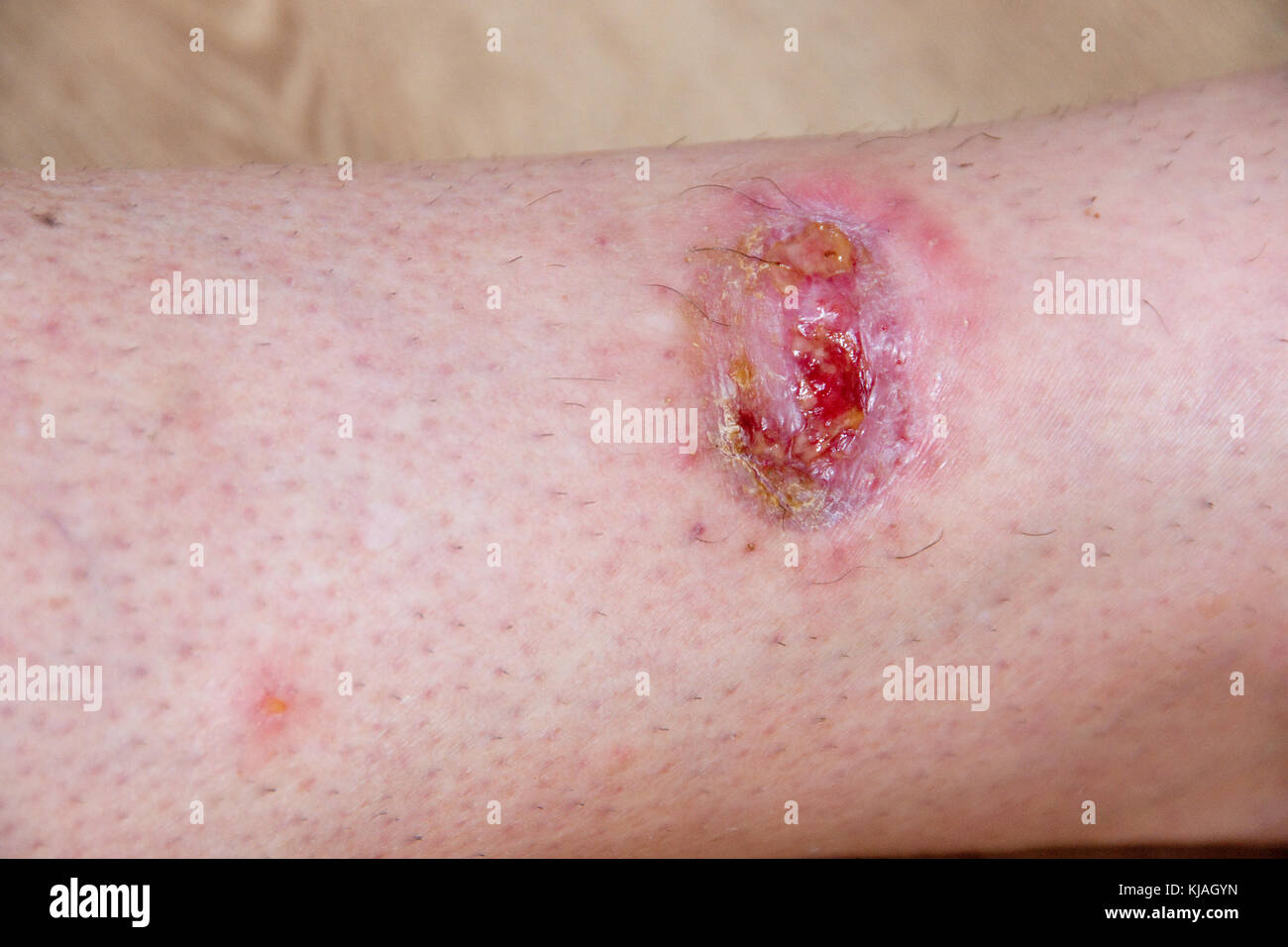 Post operative wound struggles to heal as skin graft fails : open sore wound on lower shin following removal of a tumour Stock Photo