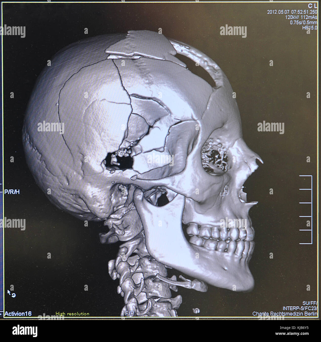 This title appears to be related to forensic medicine in Berlin, dated December 6, 2011. It may reference a case or report from the Berlin Forensic Institute, highlighting the role of forensic science in criminal investigations and legal proceedings. Stock Photo