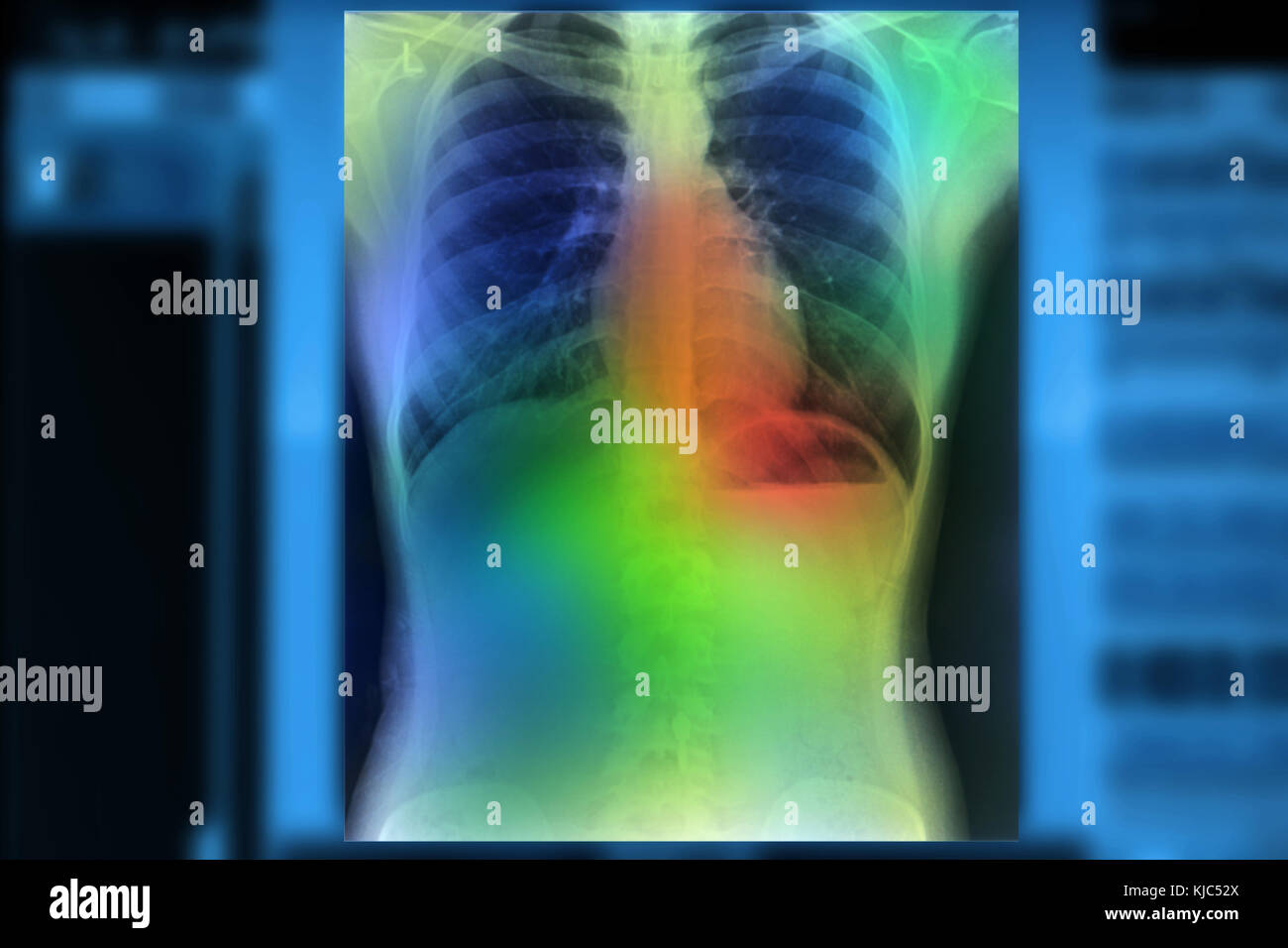Artificial intelligence in smart healthcare hospital technology concept. AI algorithm and machine learning detect Pneumonia and cancer cell in X-Rays  Stock Photo
