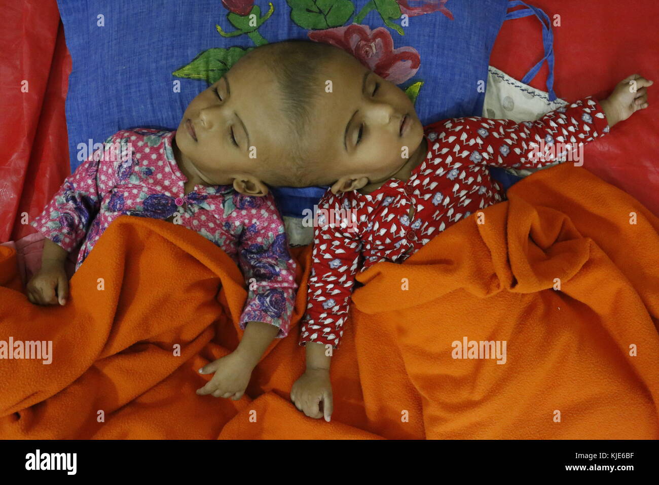 Dhaka, Bangladesh. 22nd Nov, 2017. Rabeya and Rokeya, 18 month old sister who born conjoined at head sleeping at the Dhaka Medical College Hospital (DMCH).The twins are offspring of Rafiqul Islam and Taslima Khatun from Atlongka village in Pabna's Chatmohar . Twins father Rafiqul Islam says, they have been admitted to the burn unit at the Dhaka Medical College Hospital for examination before surgery to separate their heads. Credit: Md. Mehedi Hasan/Pacific Press/Alamy Live News Stock Photo