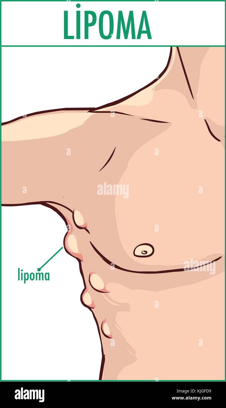 vector illustration of a lipoma. Stock Vector