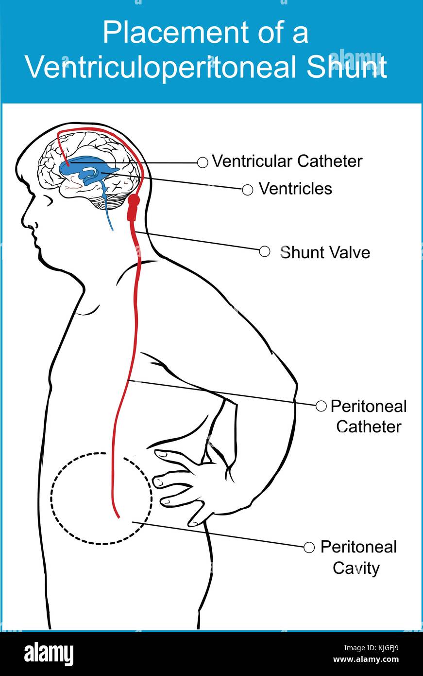 Shunt hi-res stock photography and images - Alamy