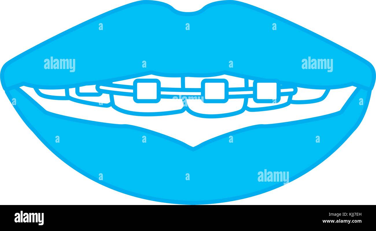 Teeth with brackets Stock Vector Image & Art - Alamy