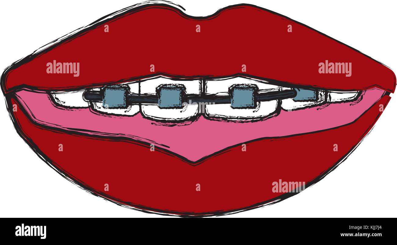 Teeth with brackets Stock Vector Image & Art Alamy