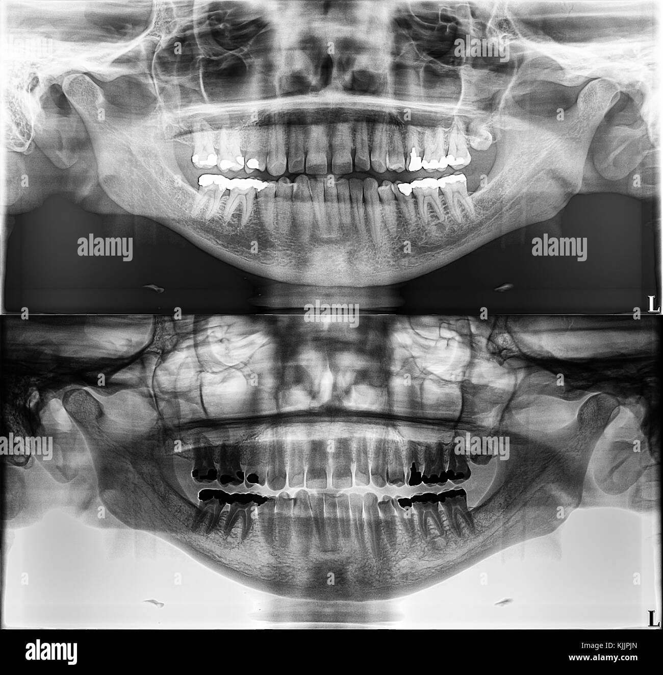 Panoramic dental Xray, fixed teeth, dental amalgam seal, wisdom tooth on side, horizontally impacted Stock Photo