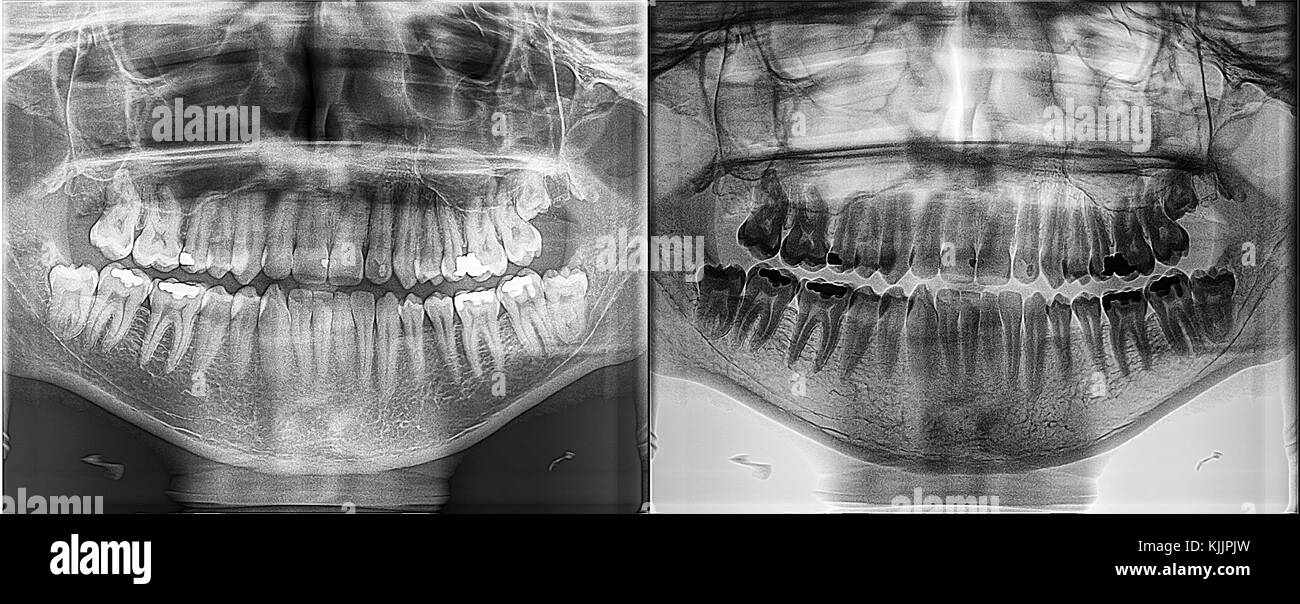 Panoramic dental Xray, fixed teeth, dental amalgam seal, wisdom teeth vertically impacted, cyst in nasal cavity Stock Photo