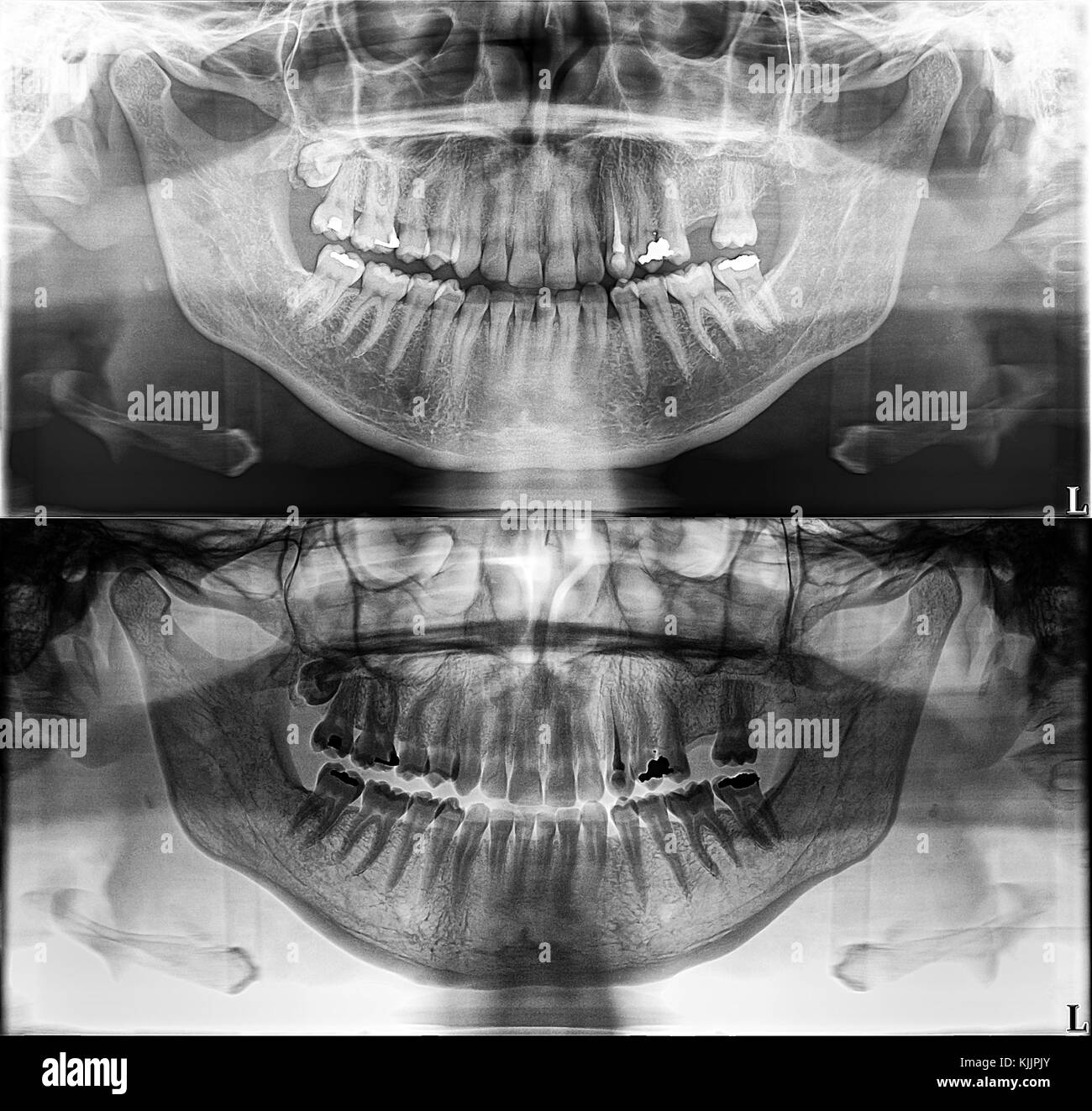 Panoramic dental Xray, fixed teeth, dental amalgam seal, dental crown and bridge, filled root canal wisdom tooth impacted Stock Photo