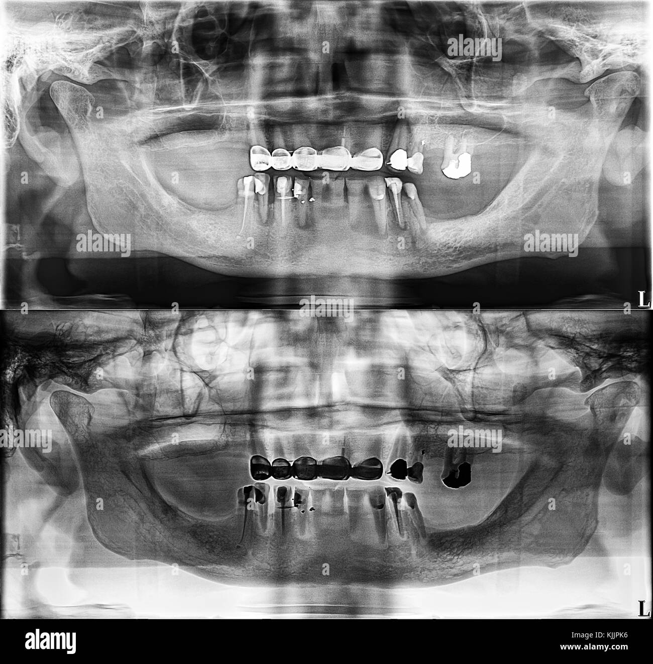 Panoramic dental Xray, fixed teeth, dental amalgam seal, dental crown and bridge, filled root canal Stock Photo