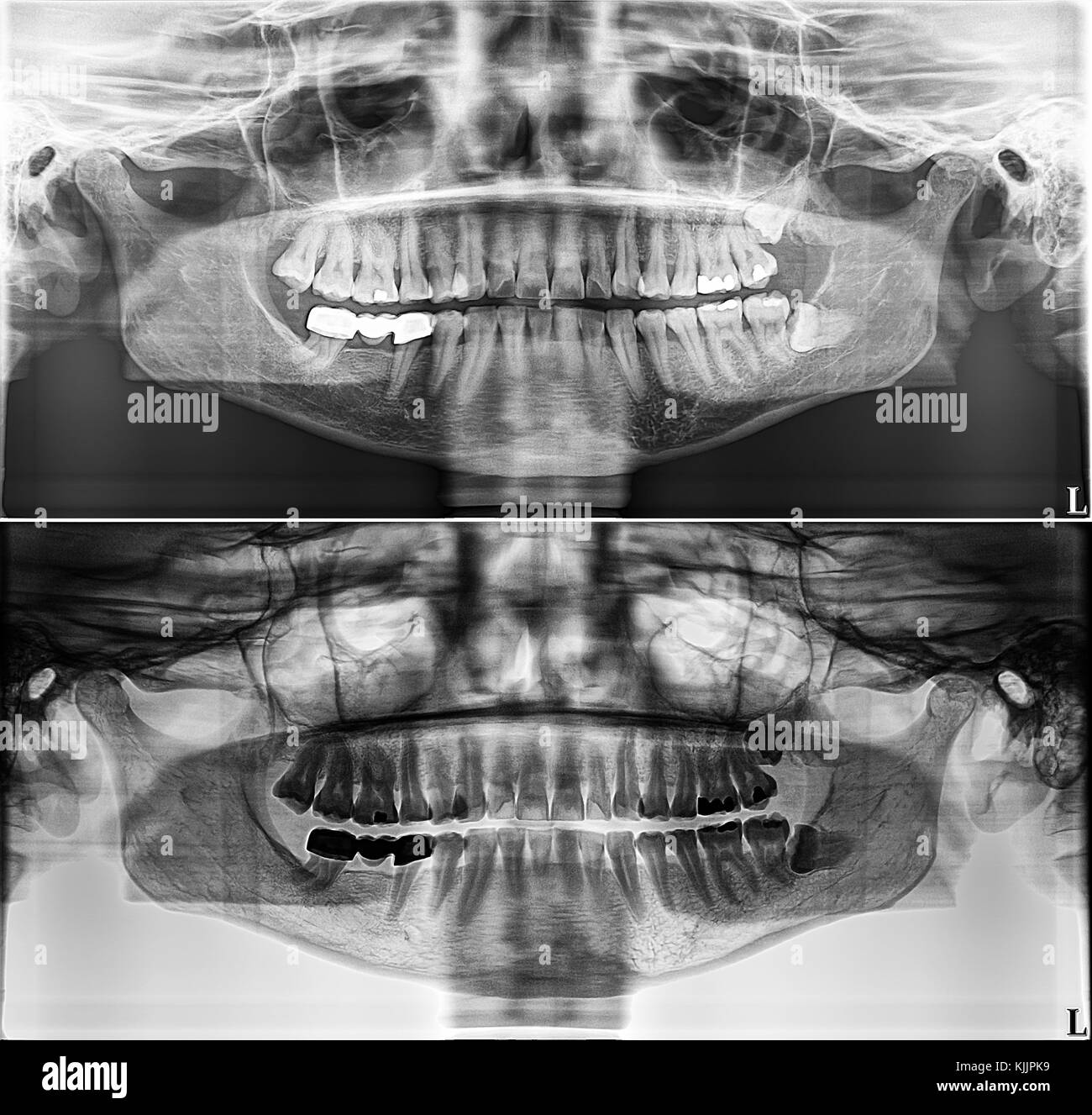 Panoramic dental Xray, fixed teeth, dental amalgam seal, wisdom teeth on side, horizontally impacted Stock Photo