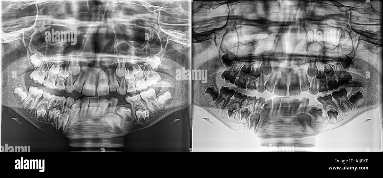 Panoramic dental Xray of a child, Deciduous - milk teeth growing from the jaw bone Stock Photo
