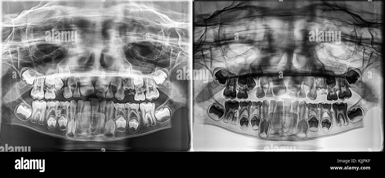 Panoramic dental Xray of a child, Deciduous - milk teeth growing from the jaw bone Stock Photo