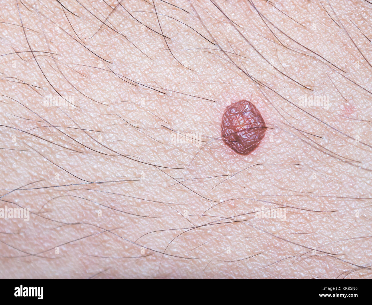 Closeup of Burn scald,Wounds caused by scalding hot water. Stock Photo