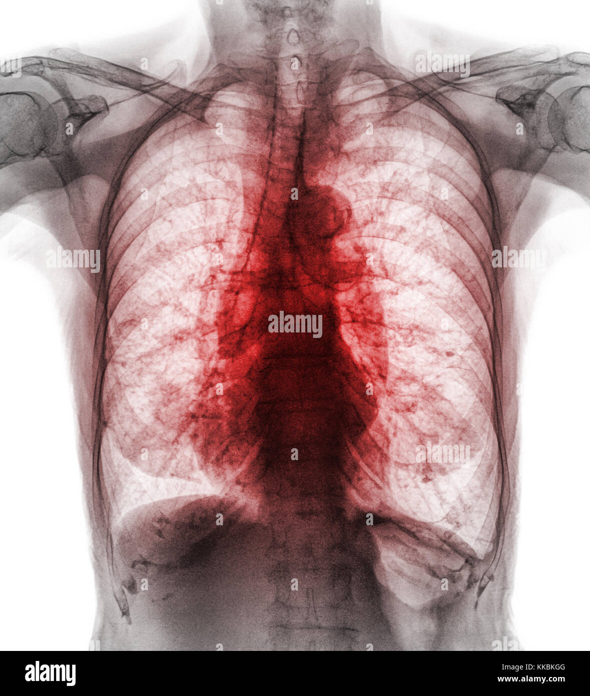 Pulmonary Tuberculosis . Film chest x-ray show interstitial infiltrate both lung due to Mycobacterium tuberculosis infection . Stock Photo