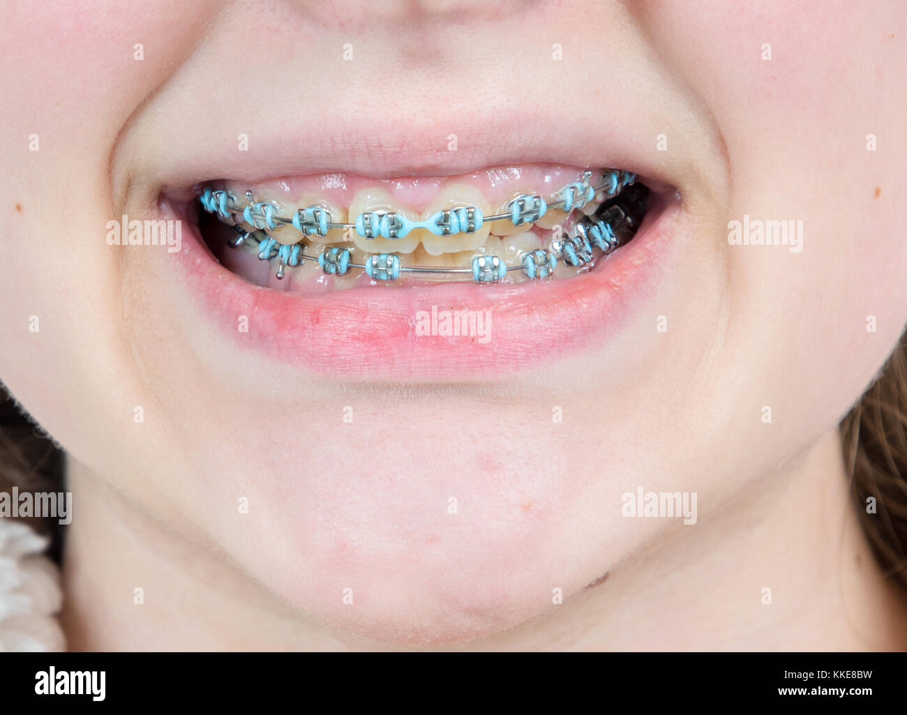 View of braces attached to a girls teeth Stock Photo Alamy
