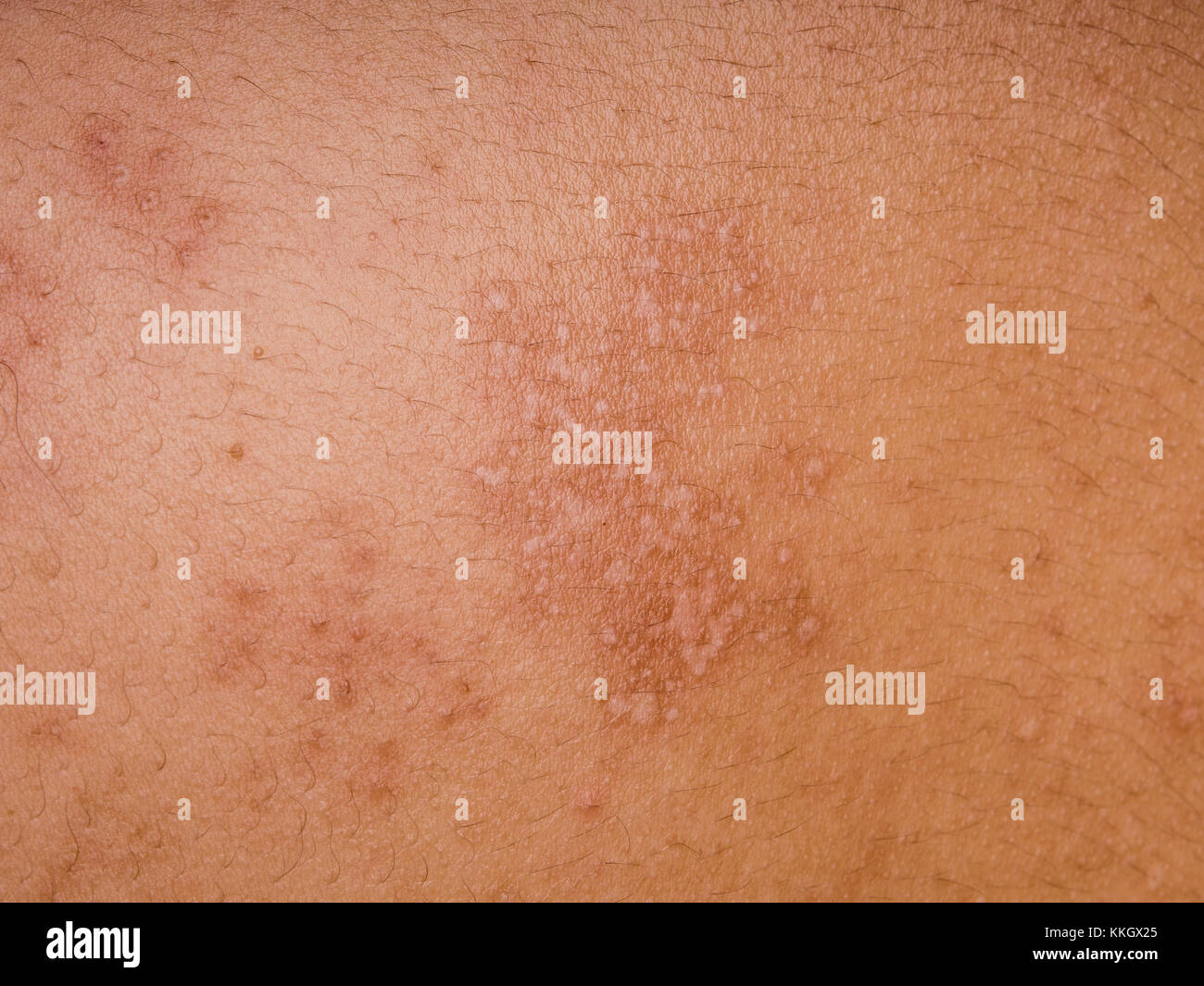 Shingles scar hires stock photography and images Alamy