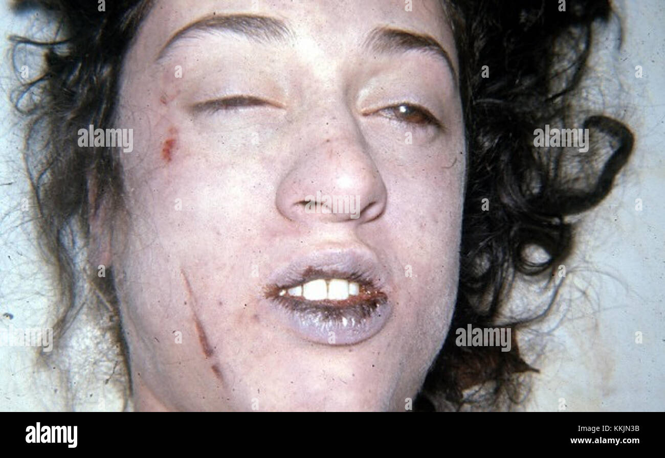 The term 'Miss X postmortem' refers to an examination or investigation conducted after the death of an individual named Miss X. The postmortem report provides insights into the circumstances and cause of death. Stock Photo