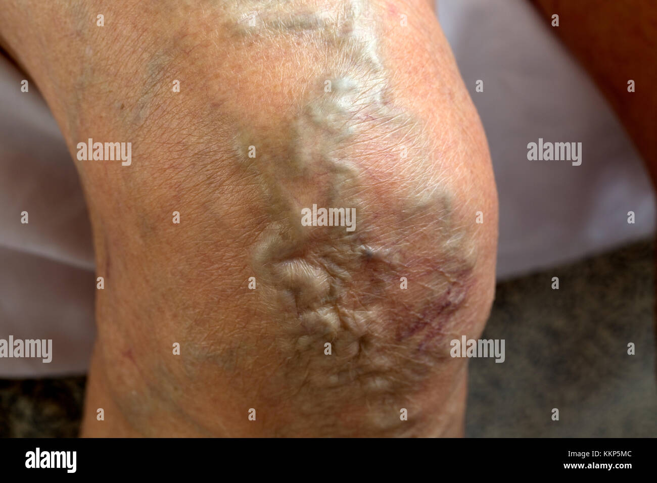 Enlarged swollen varicose veins in knee of elderly woman UK Stock Photo