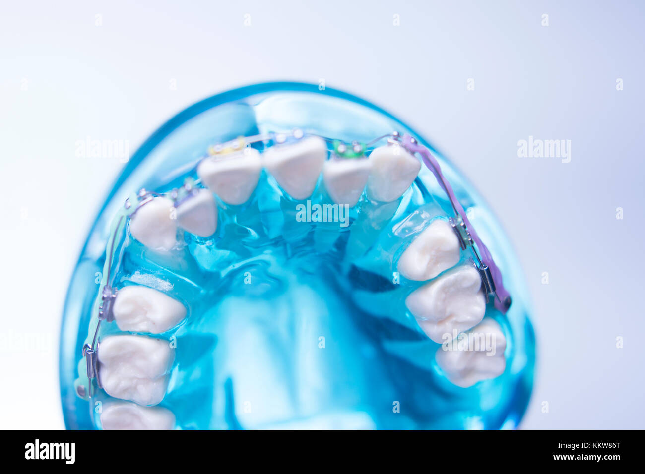 Dental teeth retainers metal aligners brackets to straighten teeth in orthodontic dentistry