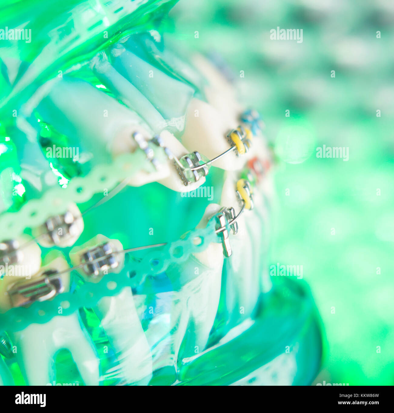 Dental teeth retainers metal aligners brackets to straighten teeth in orthodontic dentistry