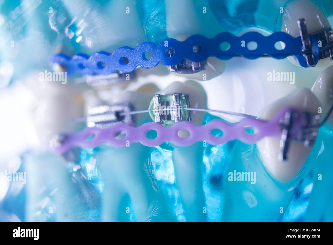 Dental teeth retainers metal aligners brackets to straighten teeth in orthodontic dentistry