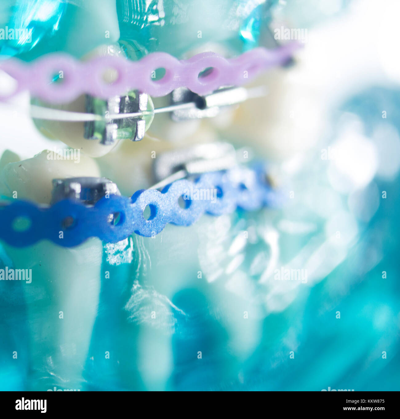 Dental teeth retainers metal aligners brackets to straighten teeth in orthodontic dentistry