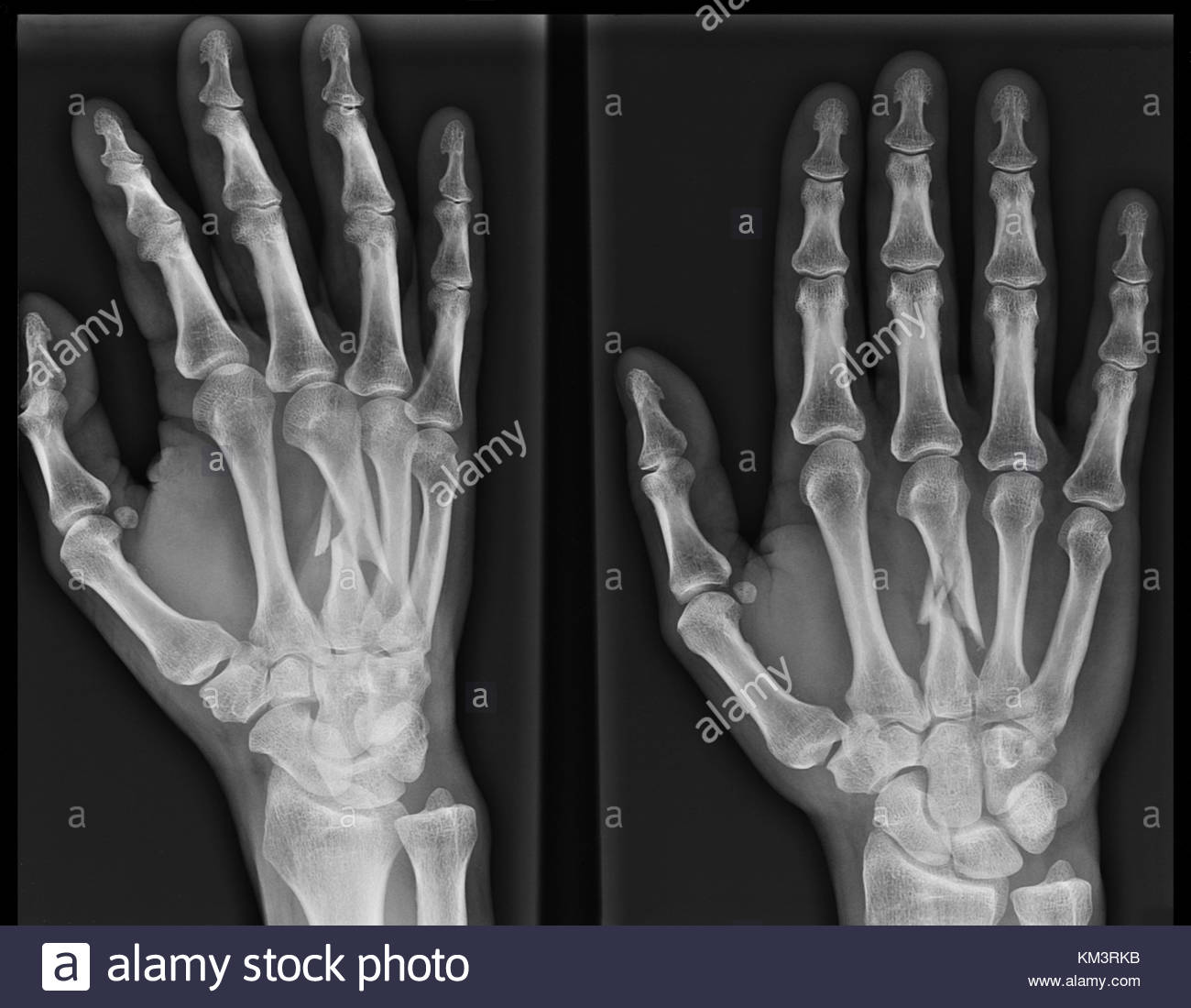 1st metacarpal fracture
