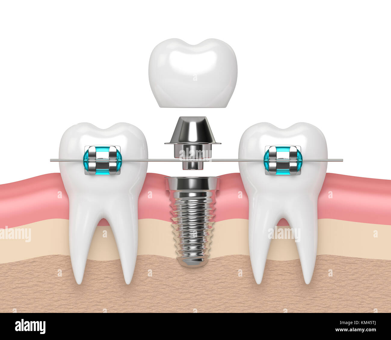 3d render of teeth with dental implant and braces over white Stock ...