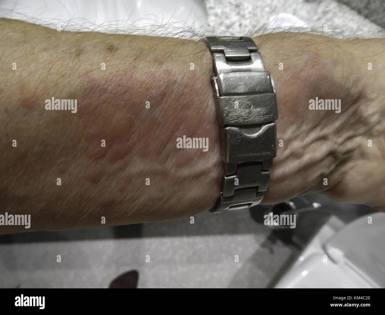 Nettle Rash High Resolution Stock Photography and Images Alamy