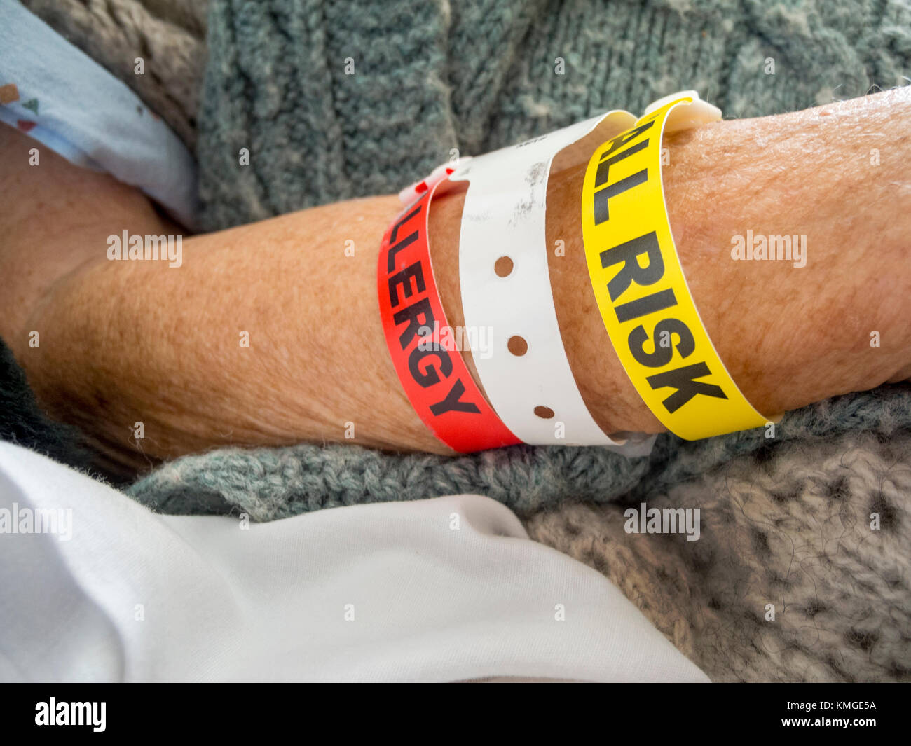 Arm bands on a female hospital patient in Irvine, CA, warn medical personnel of specific patient