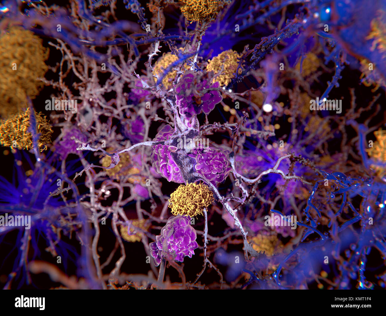 Alzheimer's disease.Computer illustration of amyloid plaques (yellow) amongst neurons.Amyloid  plaques are characteristic features of Alzheimer's disease.They lead to degeneration of the affected neurons,which are destroyed through the activity of microglia cells (violet). Stock Photo