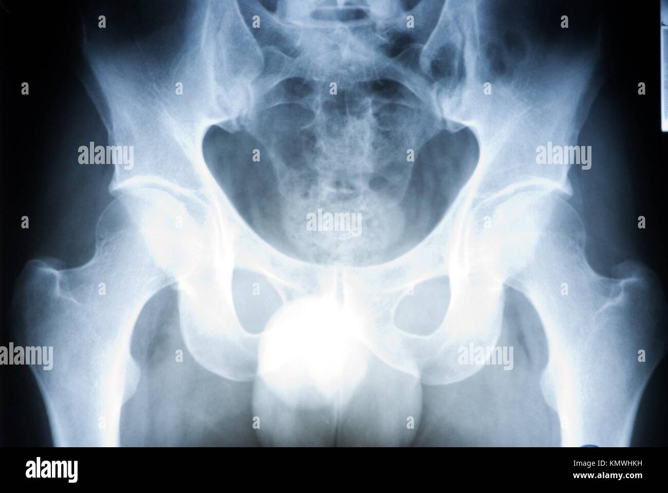 Hip X ray Stock Photo Alamy
