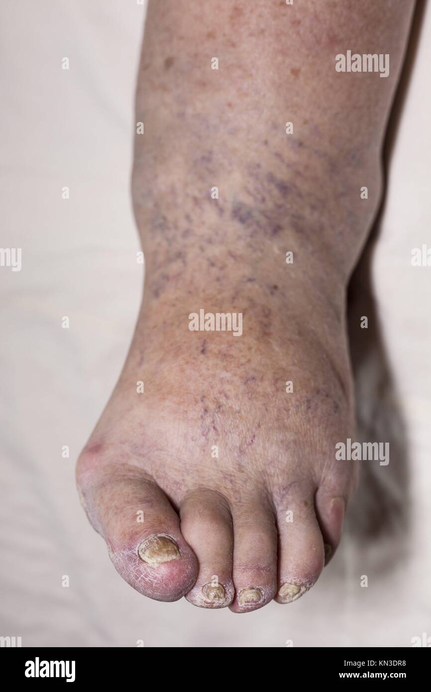 Leg Infection High Resolution Stock Photography And Images Alamy