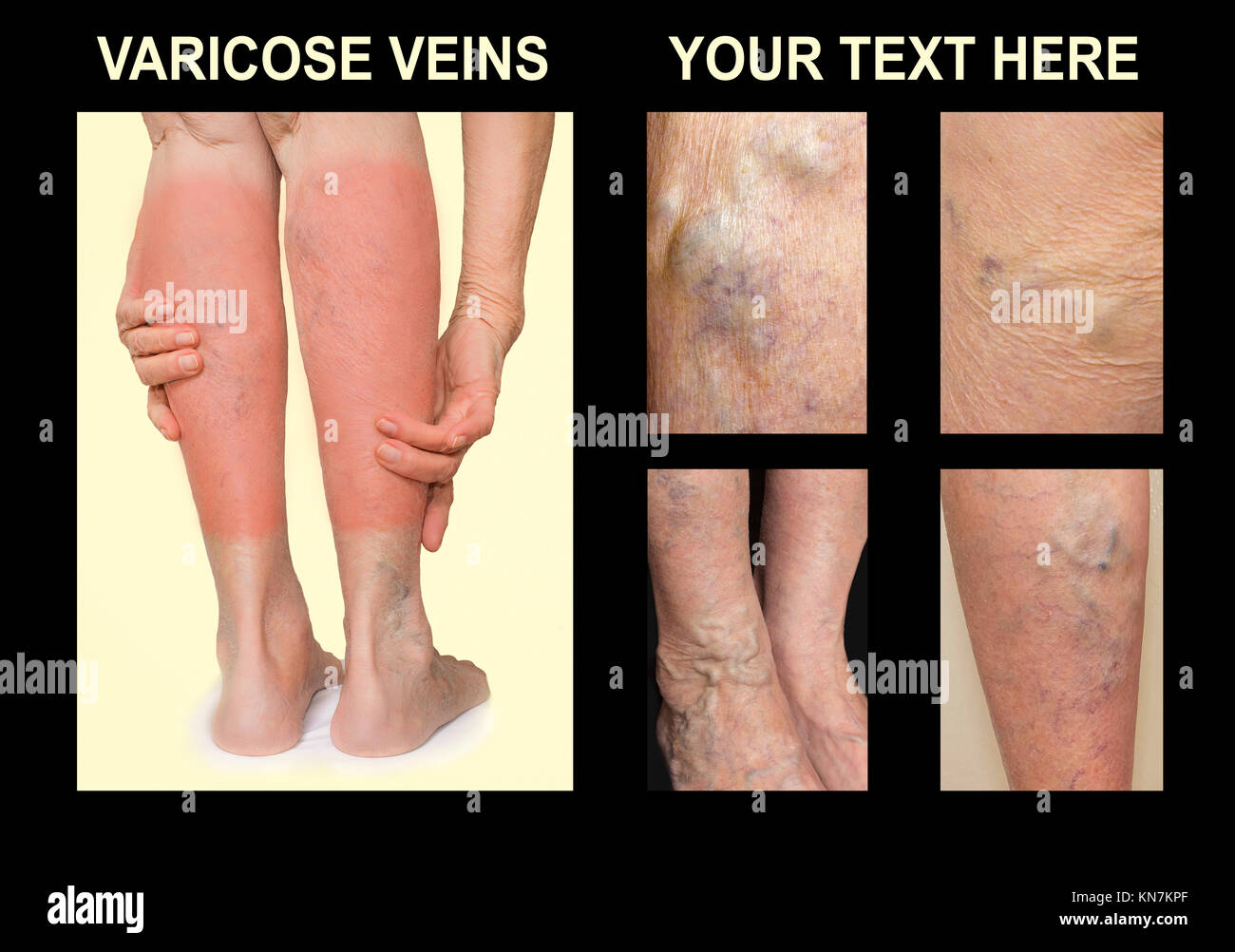 Painful varicose veins,,spider veins, varices on a severely affected