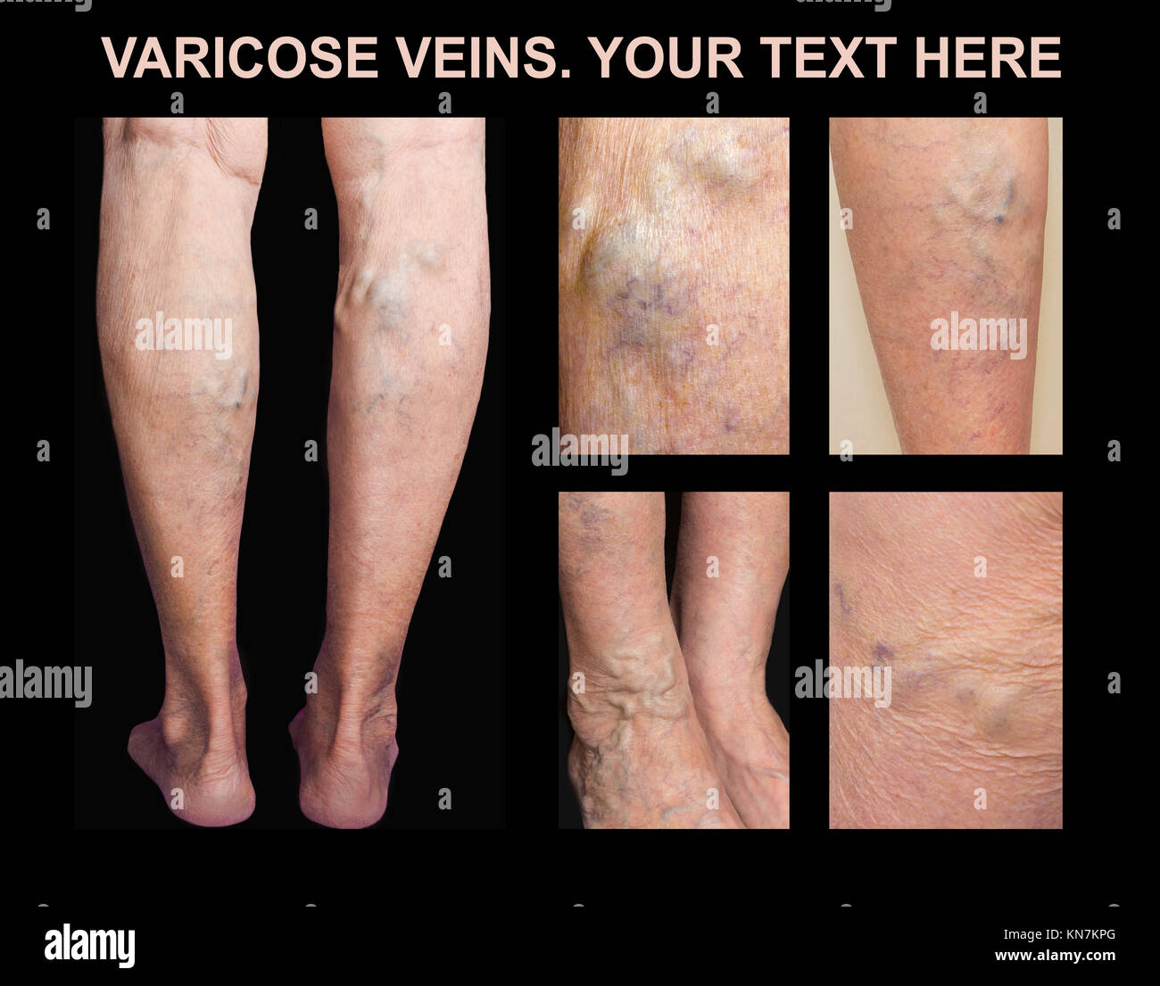 Painful varicose veins,,spider veins, varices on a severely affected