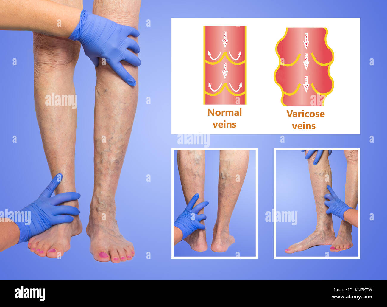 Varicose veins on a female senior legs. The structure of normal and